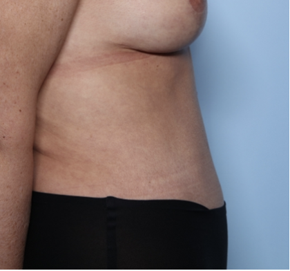 Tummy Tuck Before & After Patient #34291